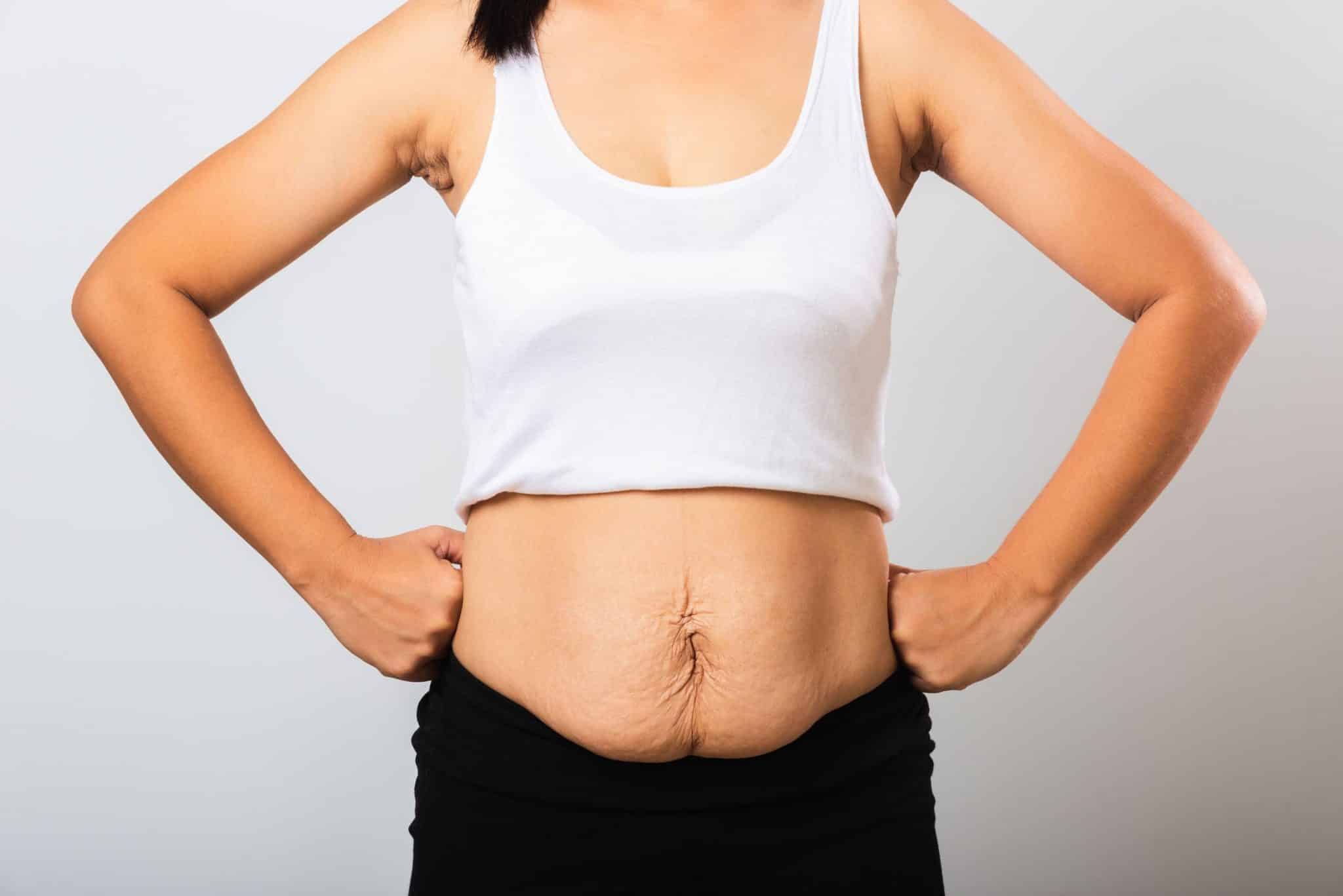 stretch mark after pregnancy