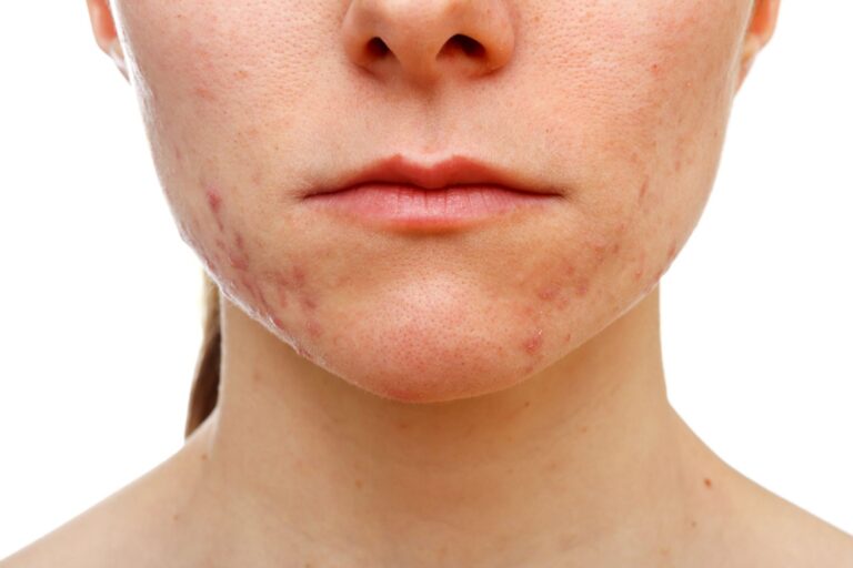 women with acne scars