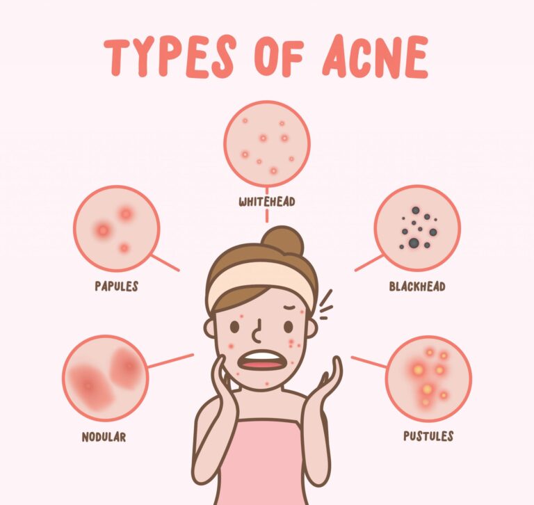 types of acne