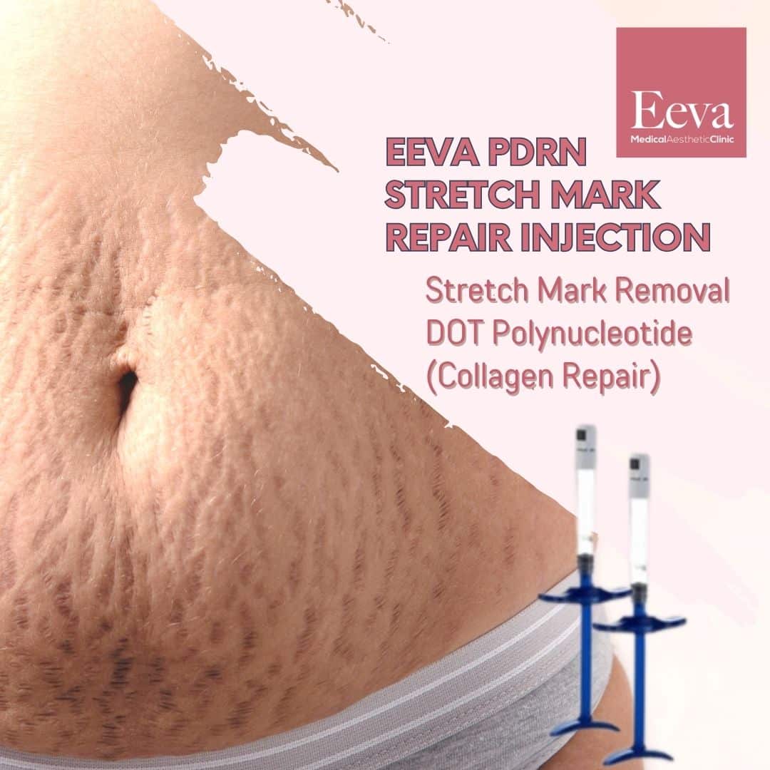 stretch marks removal rejuran healer injection