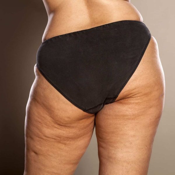 cellulite-vs-stretch-marks-min-2048x1365